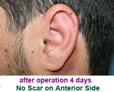 plastic-surgery-prominent-ear 